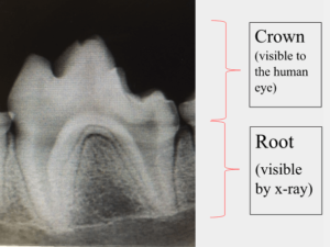 X-ray image of crown and root of a tooth